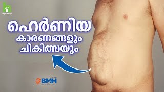 ഹെർണിയ വരാനുള്ള പ്രധാന കാരണം  Hernia Malayalam Health Tips [upl. by Rodgers]