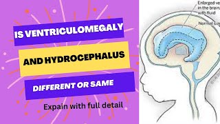 Explain with detail ventriculomegaly or hydrocephalus [upl. by Ianthe]