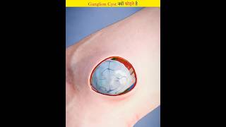 Why is ganglion cyst ruptured with Bible [upl. by Harriette209]