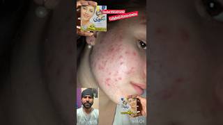 Original Goree cream pakistani cream pimple amp pigmentation shortvideo shorts short [upl. by Hunley462]