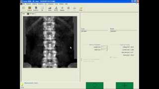 TBS in your clinical practice with GE Lunar DXA [upl. by Langelo]