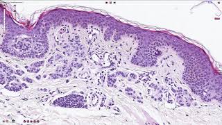 Compound Melanocytic Nevus  Histopathology [upl. by Gerladina]