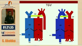 Atelier  Quand penser à une cardiopathie en salle de naissance et que faire  S Abakka [upl. by Ahsiruam532]