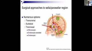 Pituitary Tumors What You Need to Know about Surgery Webinar [upl. by Annwahsal]