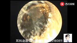 Ear endoscope cleaning the external auditory canal and answering common questions [upl. by Eitak930]