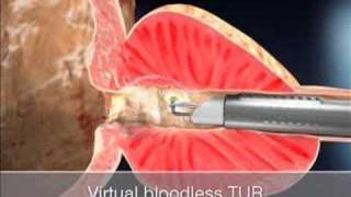 TURis Plasma Vaporization [upl. by Nosyaj]