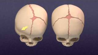 Craniosynostosis  Mayo Clinic [upl. by Nivan]