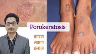 Porokeratosis का कारण लक्षण और इलाज़  Porokeratosis और cancer porokeratosis skincancer cancer [upl. by Waiter181]