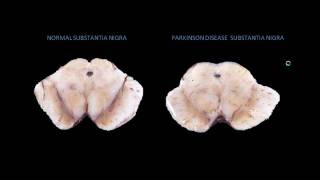 Parkinson Disease Pathophysiology Animation [upl. by Hpeosj748]