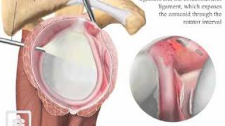 Arthroscopic capsular release for frozen shouldermov [upl. by Callie]