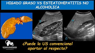 HIGADO GRASO  ESTEATOHEPATITIS [upl. by Shererd339]