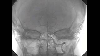 Selective Intraarterial Thrombolysis for Cardioembolic Stroke [upl. by Centonze996]