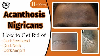 Acanthosis Nigricans How to Get Rid of Dark Neck amp Armpits  Dr Nivedita Dadu [upl. by Letizia]