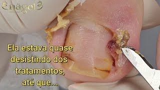 😭 A PACIENTE JÁ NÃO AGUENTAVA MAIS TADINHA  Granuloma de grau IVsatisfying viral [upl. by Aifas587]