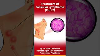 Treatment of Follicular Lymphoma by DrSurajChiraniyaHematologist lymphoma bloodcancer cancer [upl. by Bradly296]