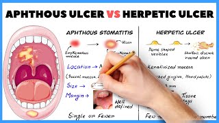 Aphthous ulcer Aphthous stomatitis vs Herpetic ulcer  How to diagnose [upl. by Ahsetra860]