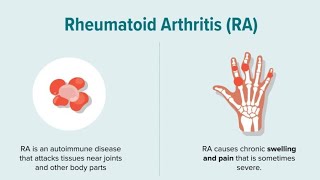 rheumatoid arthritis homeopathymedicine [upl. by Maxi411]