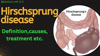 Hirschprungs disease  megacolon  aganglionic megacolon [upl. by Sosna]