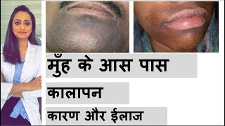 मुँह के आस पास कालापन  कारण  इलाज  darkness around mouth  home remedies dermatologist [upl. by Ahsitil]