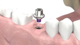 SIC invent Dental Implant  Prosthetic Animation Single Crown Closed Tray Technique [upl. by Dixil]