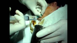 TMJ Arthrocentesis Artrocentesis de Articulacion Temporo Mandibular [upl. by Lehacim]