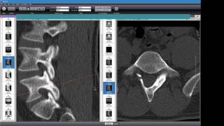 Failed Posterior Lumbar Fusion Part 2 of 2 [upl. by Vanna]