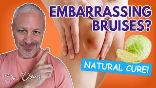 BRUISES How to get rid of them Fast  Dr Doug Willen [upl. by Yeclek]