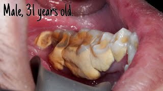 Half Jaw Quarter Hour Scaling  Dentist  Dokter Gigi Tri Putra [upl. by Pasahow752]