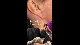 Pixie Ear Correction Explained by Dr Kian [upl. by Onileva718]