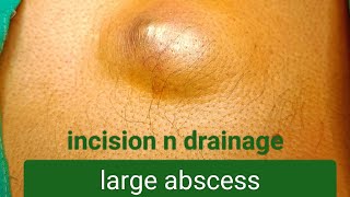 large abscess  incision n drainage dr youtube doctor [upl. by Aiekahs]