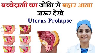 बच्चेदानी का बाहर आना यह क्यों होता है उसका इलाज  Uterus Prolapse [upl. by Pennebaker]