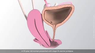 Vaginal hysterectomy [upl. by Tabshey]