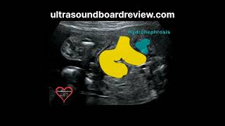 Hydronephrosis Fetal Ultrasound [upl. by Aniretak907]