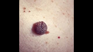 Dermatology Wk10WedSpr20 Melanocytic Nevi Moles [upl. by Shandeigh]