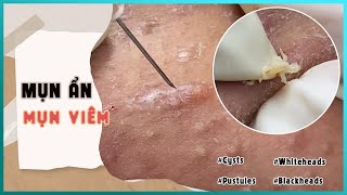 Big Cystic Acne Blackheads Extraction Blackheads amp Milia Whiteheads Removal Pimple Popping [upl. by Markiv]