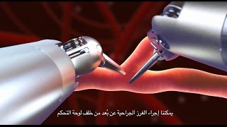 Totally Endoscopic Robotic Coronary Bypass TECAB [upl. by Nurat]