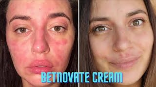 Betnovate C CREAM use  benefits  Side effects  betnovate C cream review in 2024 [upl. by Aicaca11]