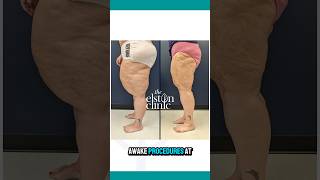 Lipedema Liposuction Transformation In Under 30 Seconds [upl. by Enamrahs]