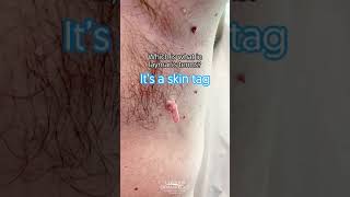 Removing an Underarm Skin tag shorts CONTOUR DERMATOLOGY [upl. by Pantia]