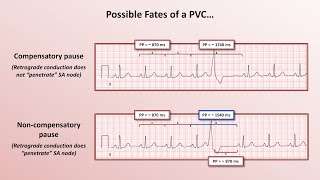 Advanced EKGs  PACs and PVCs ie premature beats [upl. by Kaitlynn]