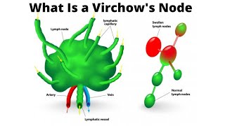 What Is a Virchows Node [upl. by Sandye971]