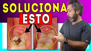 🚩Encía 𝐈𝐍𝐅𝐋𝐀𝐌𝐀𝐃𝐀 Muela del Juicio 💊Tratamiento de 𝙋𝙀𝙍𝙄𝘾𝙊𝙍𝙊𝙉𝘼𝙍𝙄𝙏𝙄𝙎 del tercer molar 𝗦𝗨𝗣𝗘𝗥𝗖𝗹𝗮𝗿𝗼 👌 [upl. by Arjun]