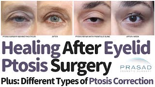 Different Types of Eyelid Ptosis Surgical Correction Techniques and Expected Healing Time [upl. by Ailssa123]