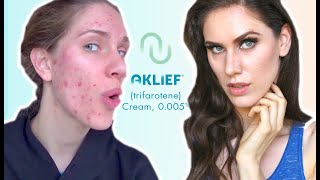 FIRST NEW ACNE MED IN 20 YEARS  AKLIEF  Trifarotene Cream 0005 Review amp Impressions [upl. by Eiram672]