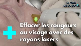 Couperose  sen débarrasser grâce au laser vasculaire  Le Magazine de la Santé [upl. by Wolenik740]