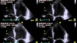 TRUE SEVERE AORTIC STENOSIS  STRESS ECHOCARDIOGRAPHY cardiac ultrasound [upl. by Razal]