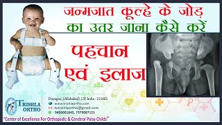 Congenital Hip Dislocation जन्मजात कूल्हे के जोड़ का उतर जाना पहचान एवं इलाज Dr J K Jain [upl. by Shurlock]