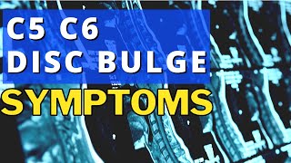 What Are The Symptoms Of A Bulging Disc In The Neck C5 C6 Disc Bulge Symptoms  Dr Walter Salubro [upl. by Yllut]