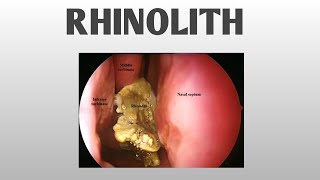 RHINOLITH  ENT [upl. by Azenav]