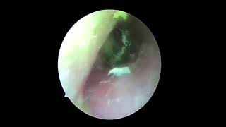 Ear wax removalsatisfying video for ear Fungus cleaning [upl. by Yrac415]